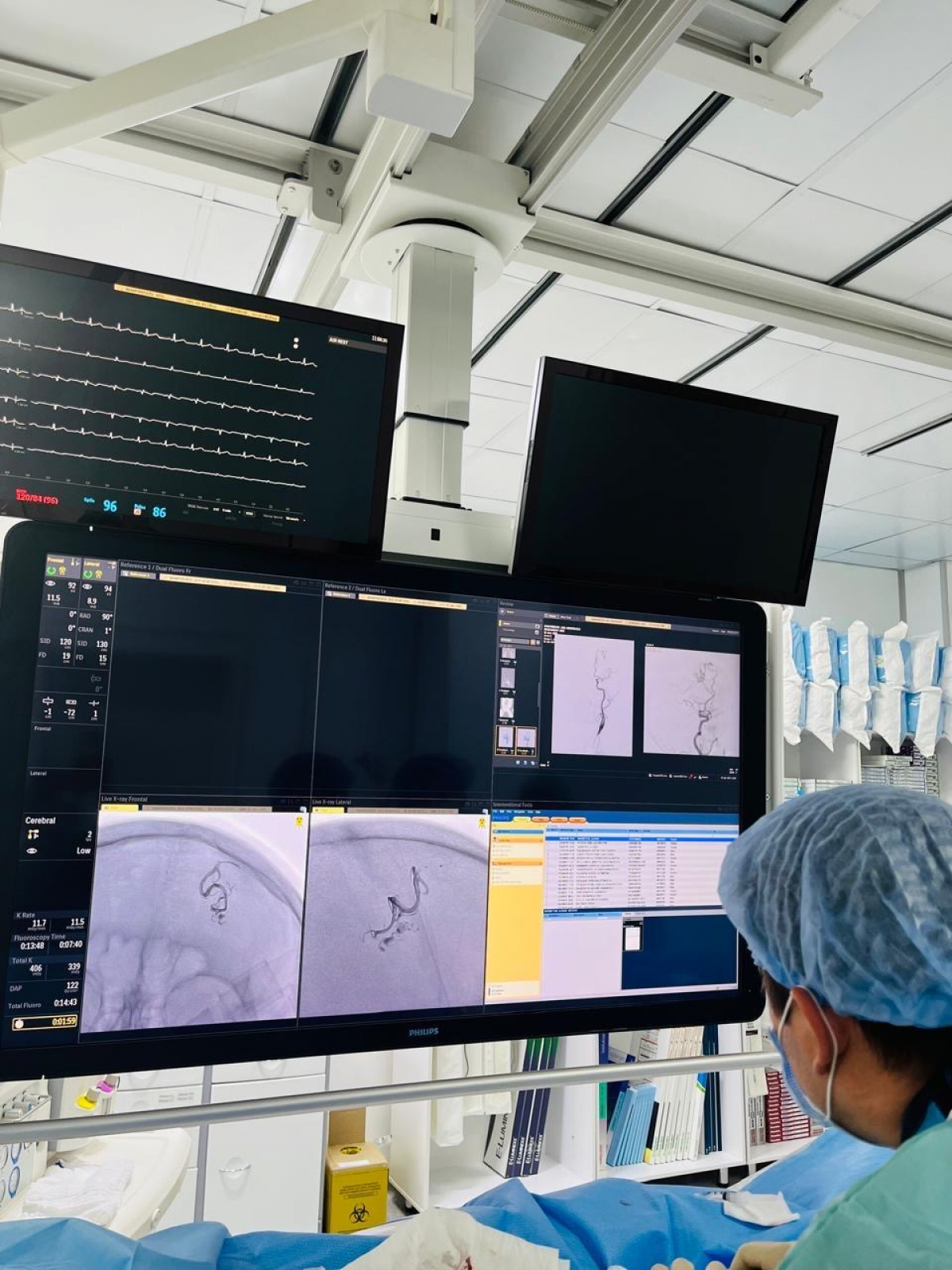 Нейрохирурги Шымкента спасли жизнь женщине с аневризмой сосудов головного мозга